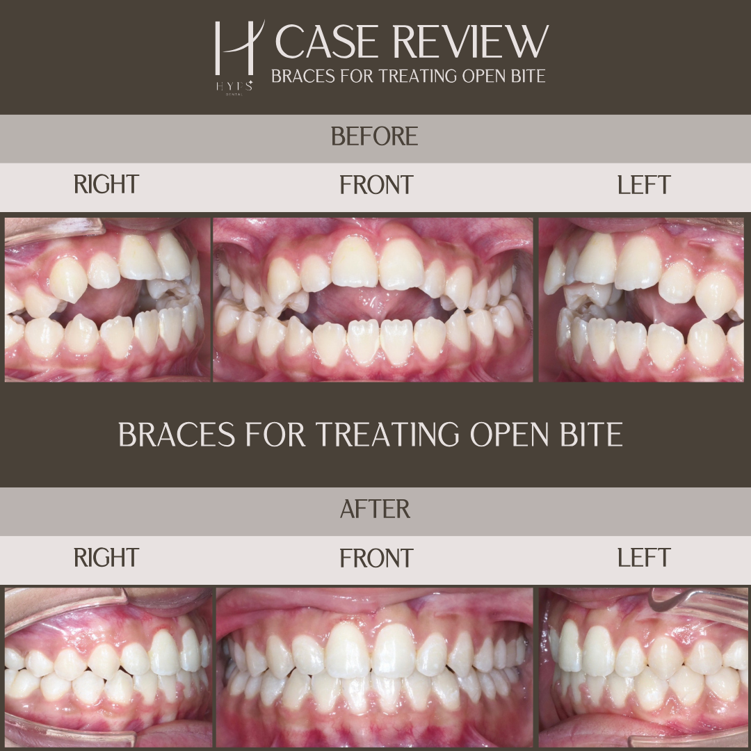 Braces - Open bite